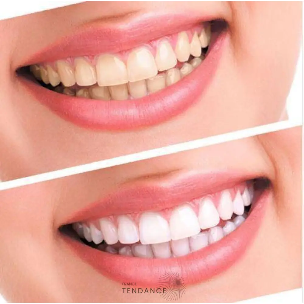 Kit De Blanchiment Dentaire | France-Tendance